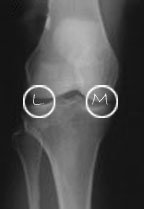 medial and lateral compartments