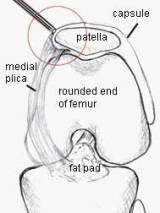 medial_plica.jpg
