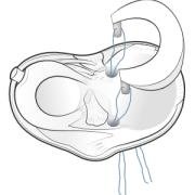 Meniscal allograft from above
