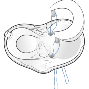 meniscal allograft with bone plugs