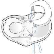 meniscal allograft (MAT)