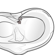 meniscal root avulsion