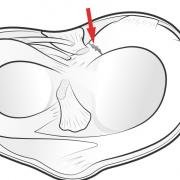 meniscal root tear
