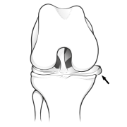 meniscal extrusion