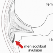 meniscotibial ligament avulsion