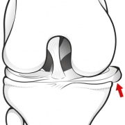 meniscus extrusion