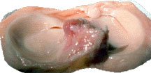 knee meniscus transplant