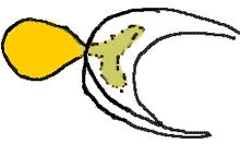 Illustration of meniscal cyst