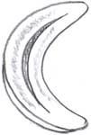 Image of meniscus with longitudinal tear
