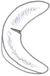 Image of meniscus with radial tear