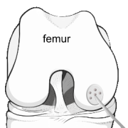 microfracture