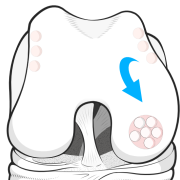 mosaicplasty
