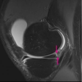 meniscus ramp lesion