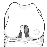 OATS - osteoarticular transfer system
