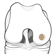 prepared defect for OATS graft