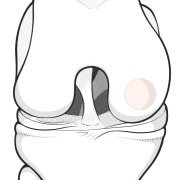 OATS procedure