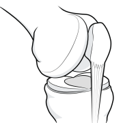 the trochlear groove from the side