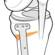 opening wedge high tibial osteotomy
