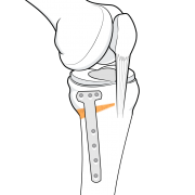 high tibial osteotomy