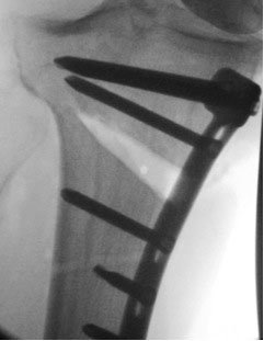 opening-wedge osteotomy