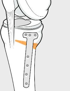 opening wedge osteotomy