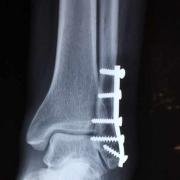 open fracture reduction at ankle