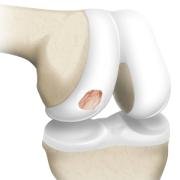 osteochondral defect