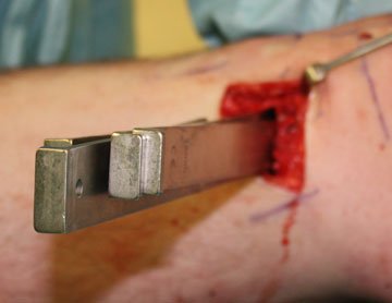 Osteotomy chisels