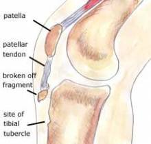 tendon avulsion