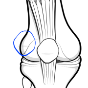 patellar dislocation