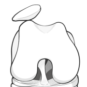 patellar subluxation