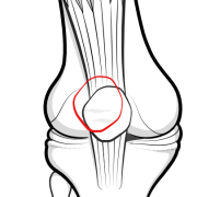 patellar subluxation