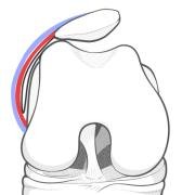 patellar-tilt.jpg