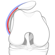 patellar tilt due to a tight lateral retinaculum