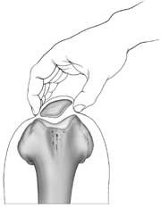 patellar palpation