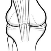 post patellectomy