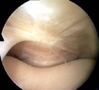 suprapatellar plica