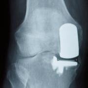 partial knee replacement