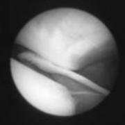 plica catching between bones - plica syndrome