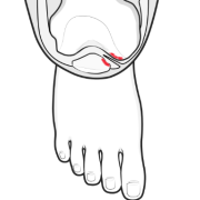 medial plica catching in joint - plica syndrome