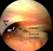 suprapatellar plica at arthroscopy