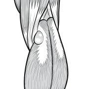 baker's cyst or popliteal cyst