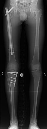 nail in femur to hold fracture