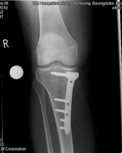 twelve weeks after osteotomy