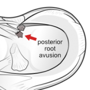 posterior root avulsion of the meniscus