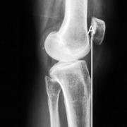 anterior tibial cortex line