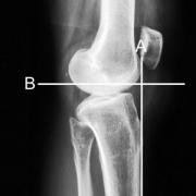 perpendicular to anterior tibial cortex line