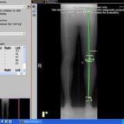 planning software for osteotomy