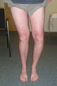 Bow legs with ligament damage