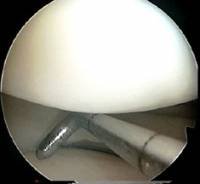 arthroscopy probe